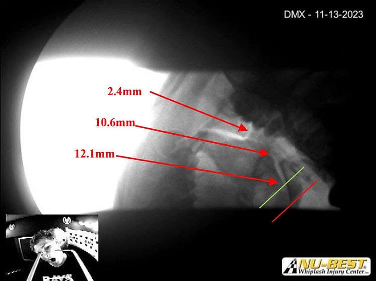 Image digital motion x-ray Idaho Motorcycle Injury Lawyer